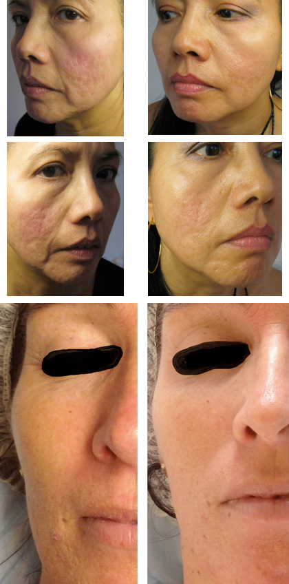 Microneedling